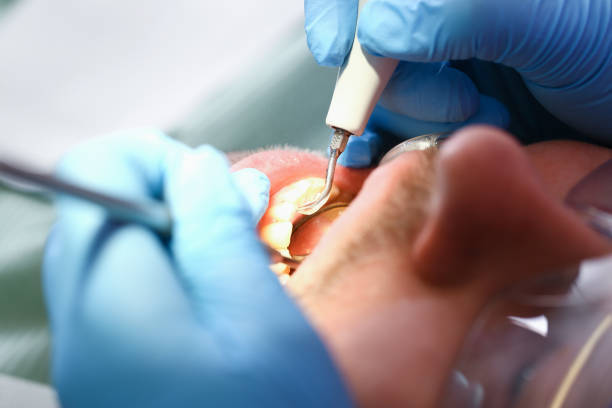 Best Emergency Wisdom Teeth Removal in Franklin, PA